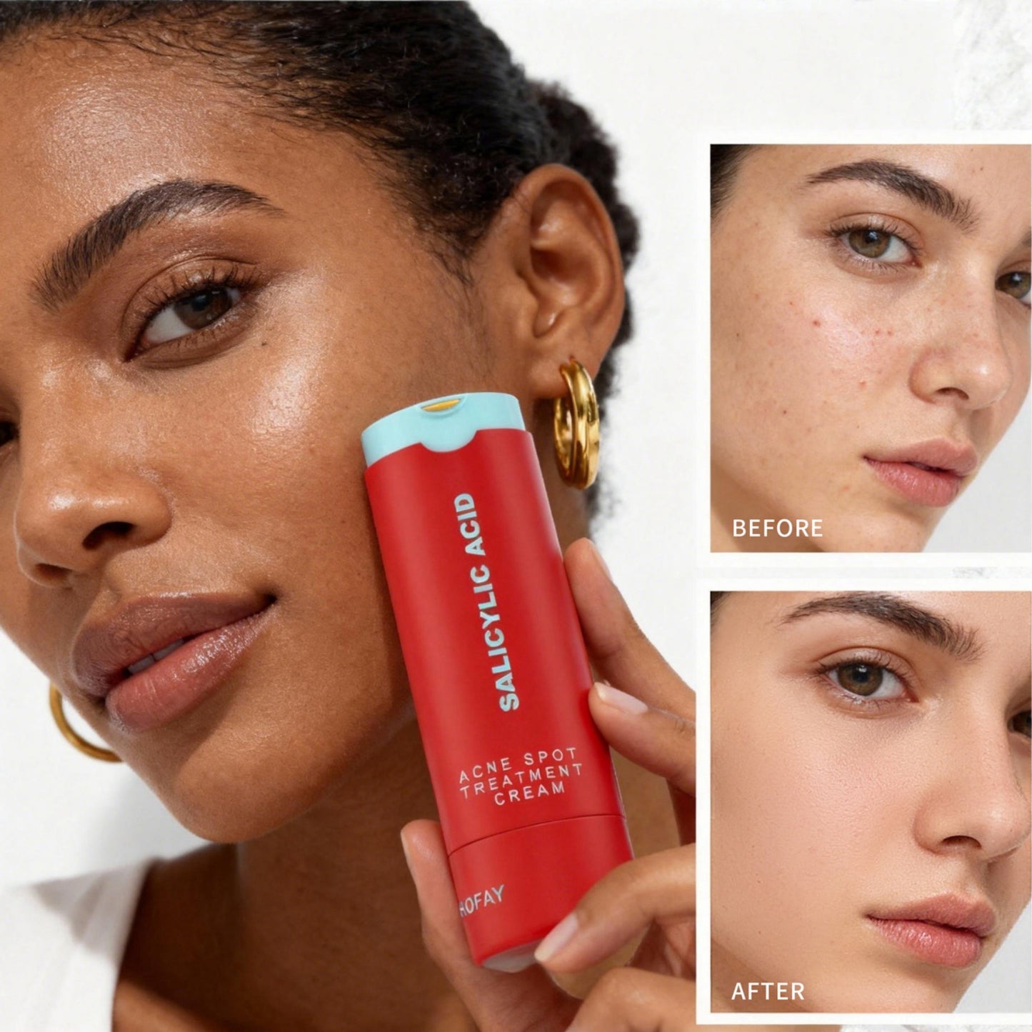 PHOFAY Acne Care Lotion